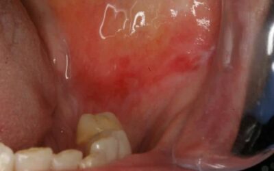 Liquen Plano bucal | Síntomas y Tratamiento