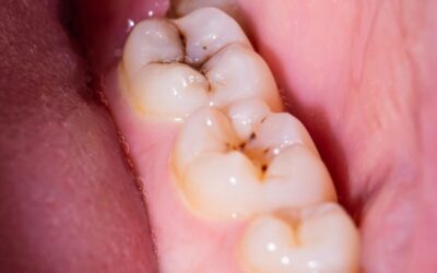 CARIES DENTALES: SINTOMAS Y TRATAMIENTOS