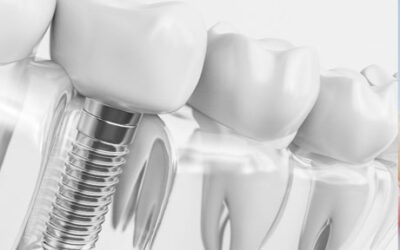 Implantes dentales de titanio en Zaragoza