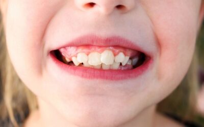 Dientes Torcidos en Niños y Adultos: Causas y Soluciones